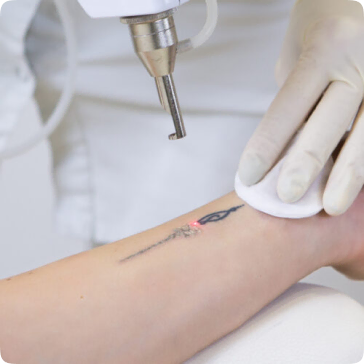 Eliminación de Tatuajes