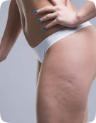Celulitis